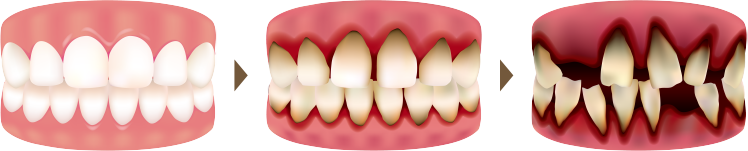 春日井市八光町・ももはな歯科クリニック・歯周病とは