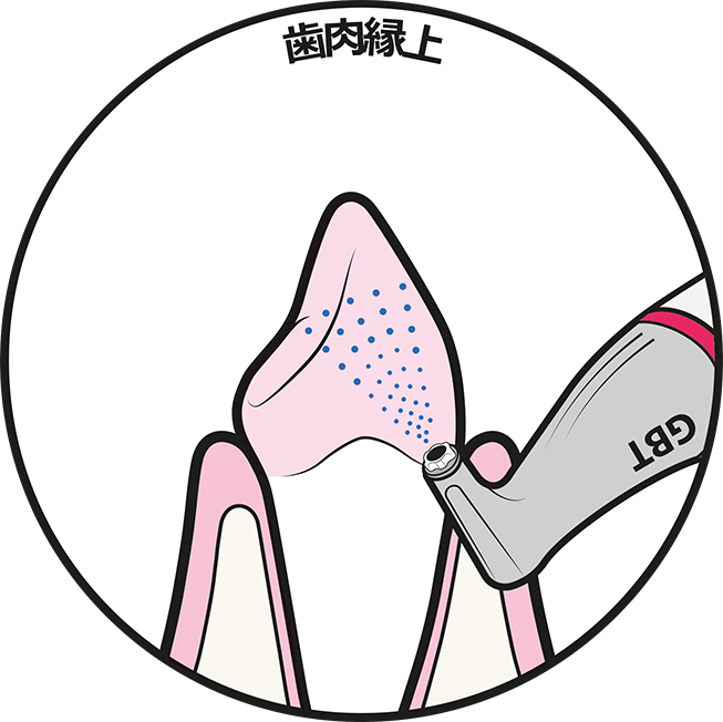 春日井市八光町・ももはな歯科クリニック・STEP4