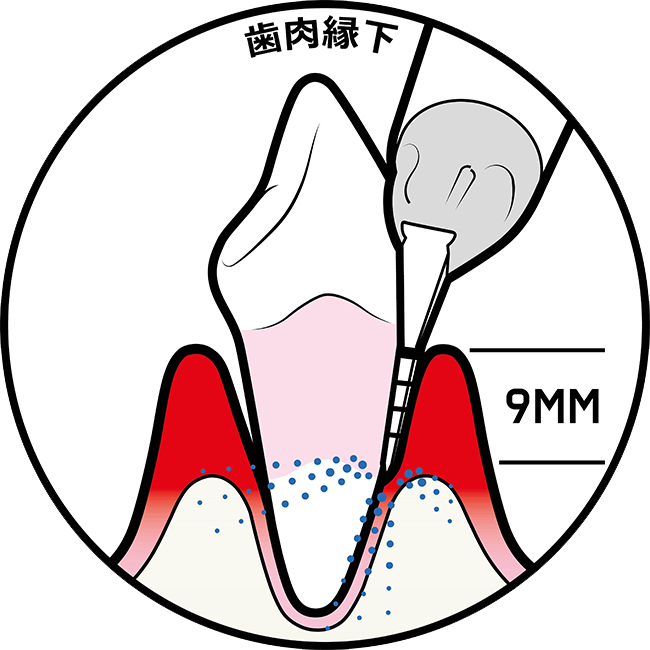 春日井市八光町・ももはな歯科クリニック・STEP5
